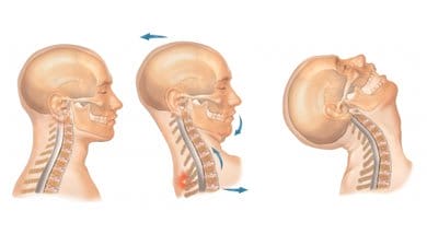 What is Whiplash? The Gift That Keeps on Giving