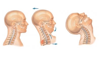 What is Whiplash? The Gift That Keeps on Giving