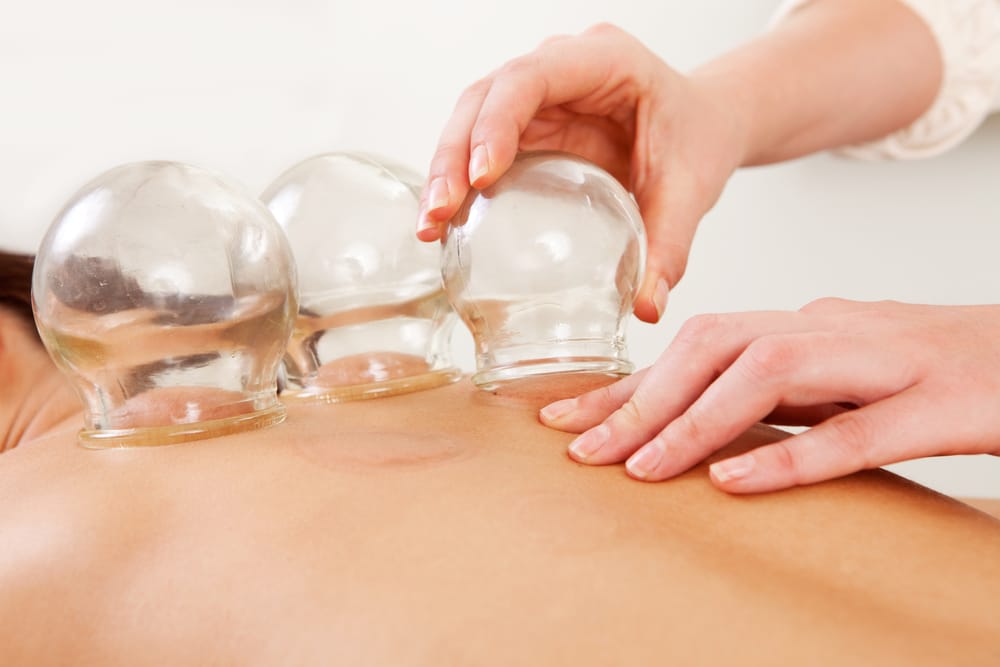 Can Cupping Help Your Muscle Pain? Dr. Sandra Doman Chiropractor Aventura